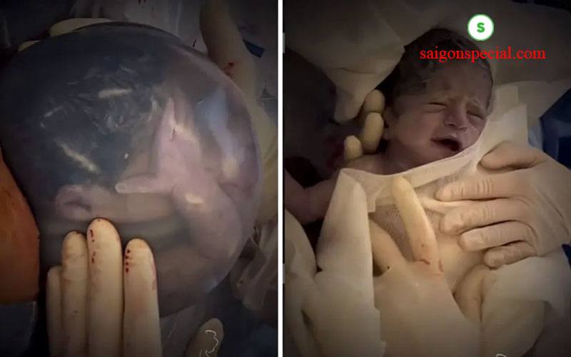 anmniotic sac about infant head photos