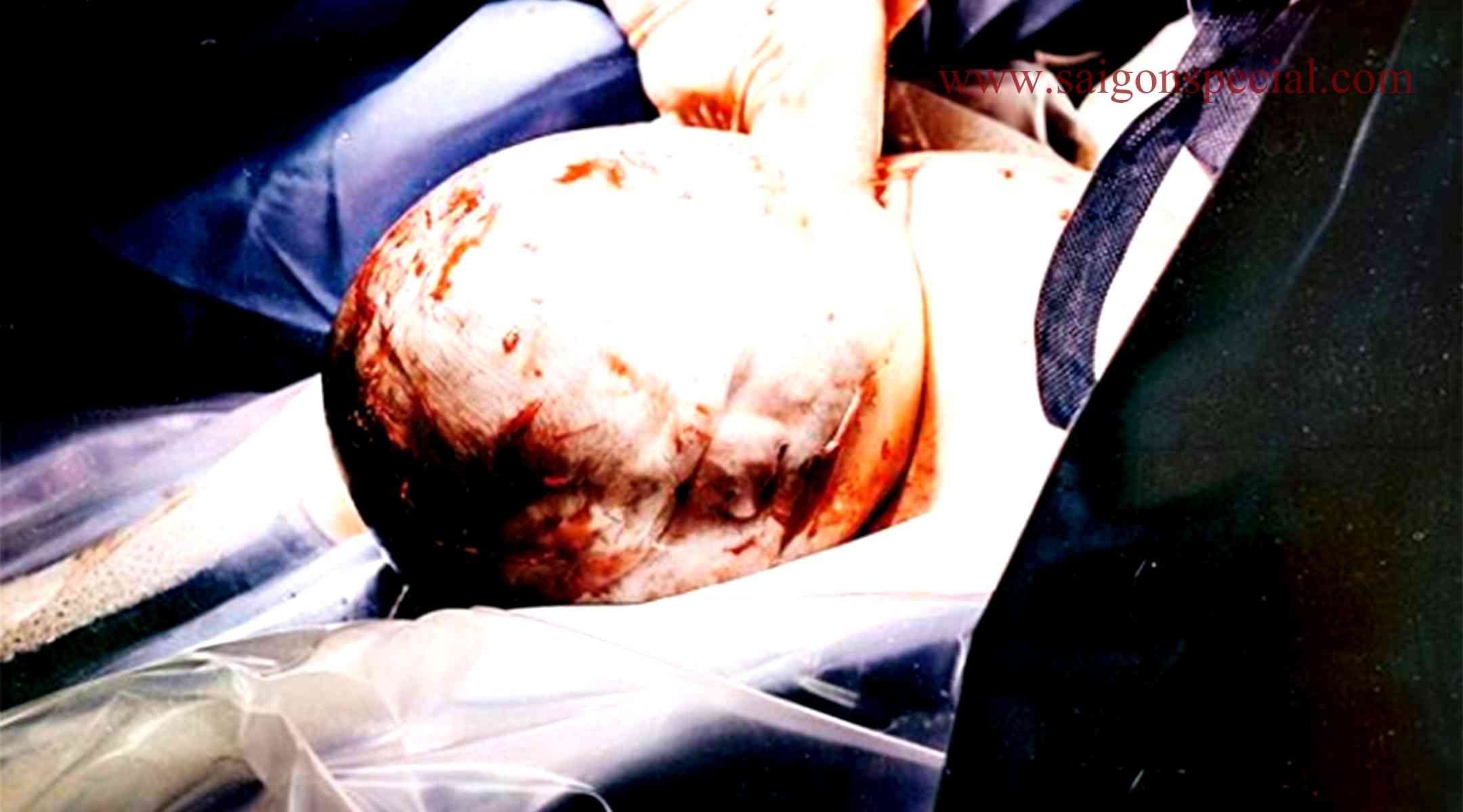anmniotic sac about infant head photos